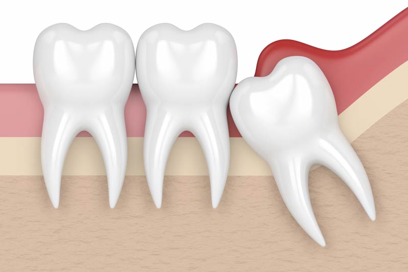 Wisdom Tooth Removal in Katy